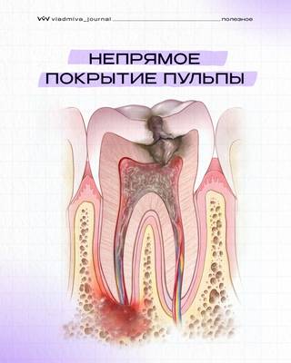 Непрямое покрытие пульпы: пошаговый протокол от диагноза до фиксации.